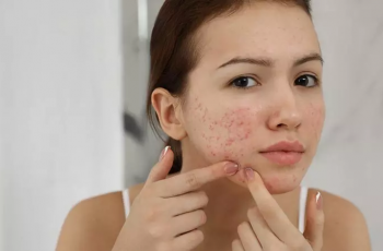 How Skin Inflammation Starts and How You Can Treat It How Skin Inflammation Starts and How You Can Treat It