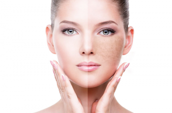 How Inflammation Triggers Hyperpigmentation and Ways to Protect Skin