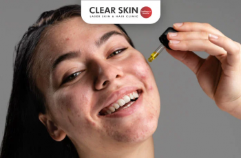 The Ultimate Guide to Fighting Acne with Salicylic Acid